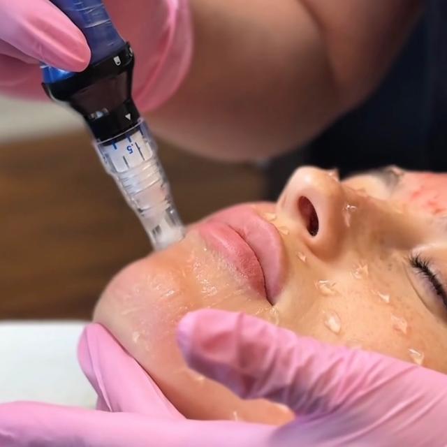 Microneedling 